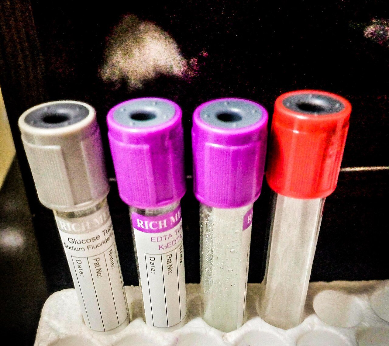 A Simple Blood Test May Flag Crohn’s and Colitis a Decade Before Symptoms Blood sample tubes being processed in a laboratory